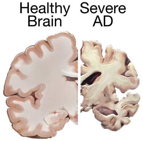 Healthy brain versus severe Alzheimer’s disease showing dementia-related degeneration